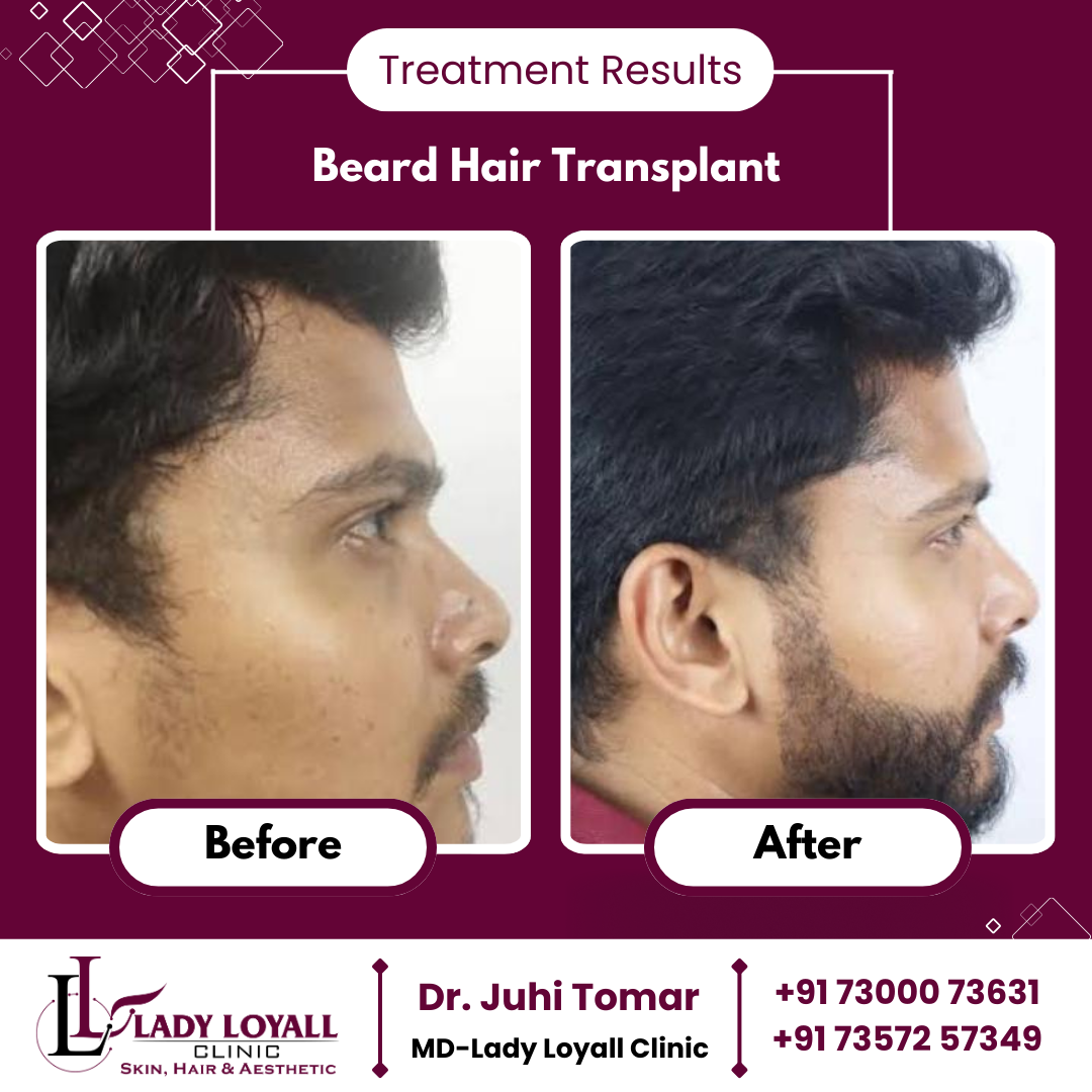 Beard Hair Transplant