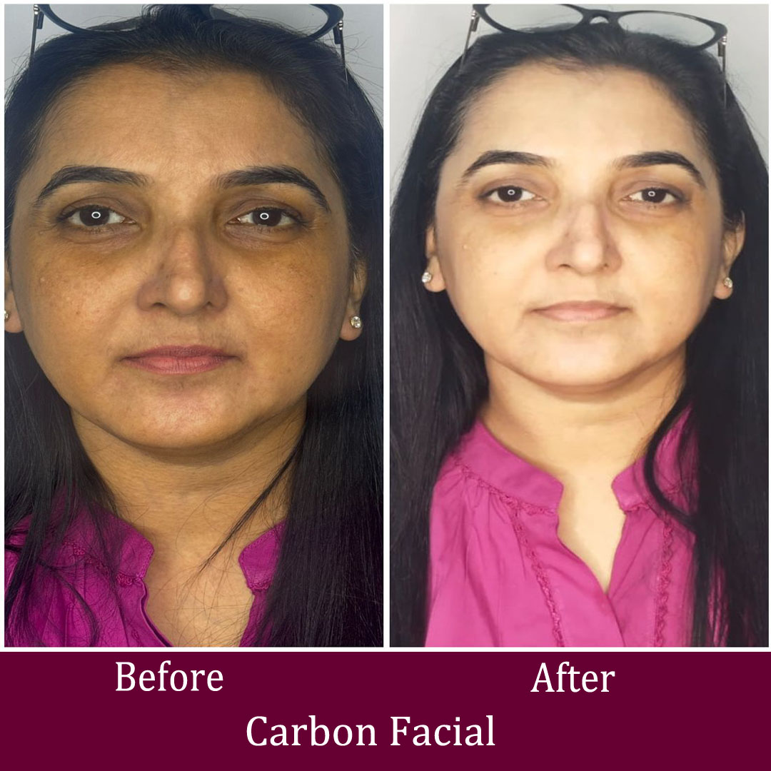 Carbon Facial