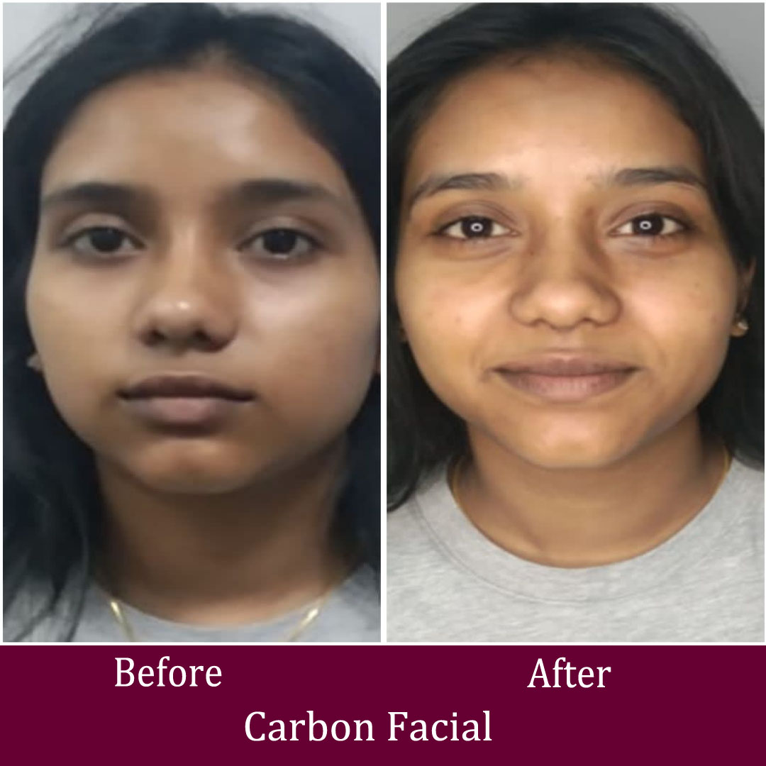 Carbon Facial