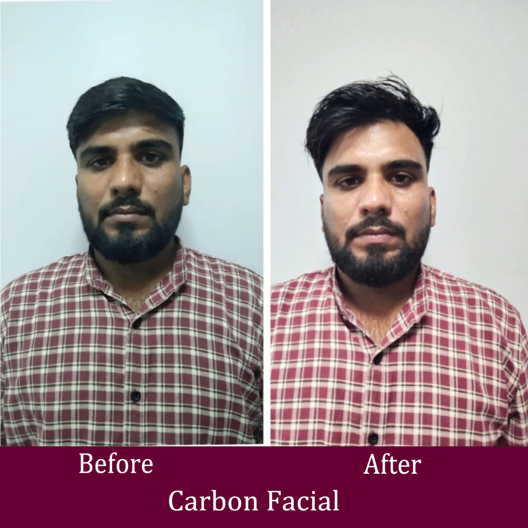 Carbon Facial