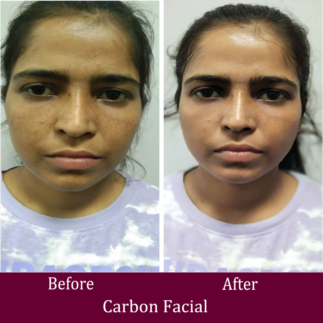 Carbon Facial