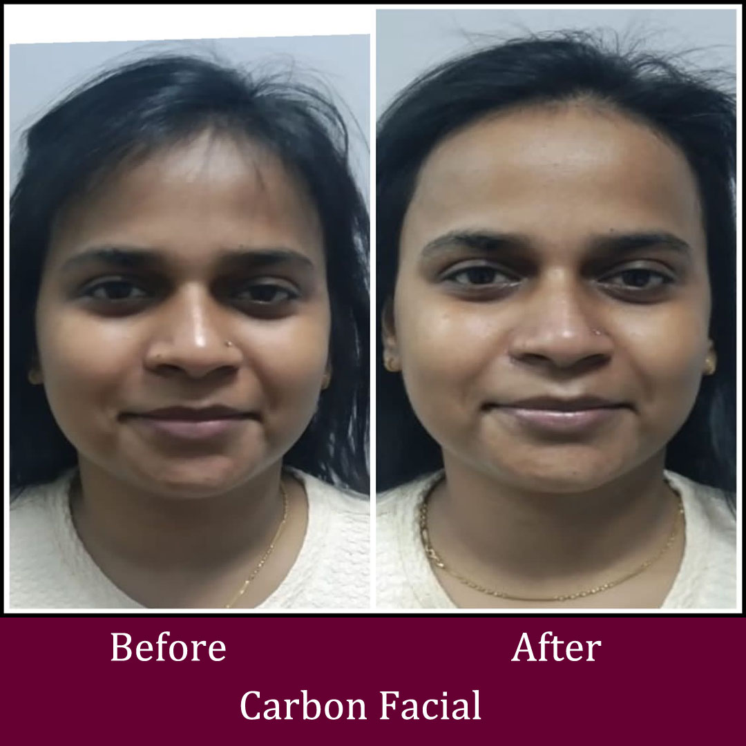 Carbon Facial