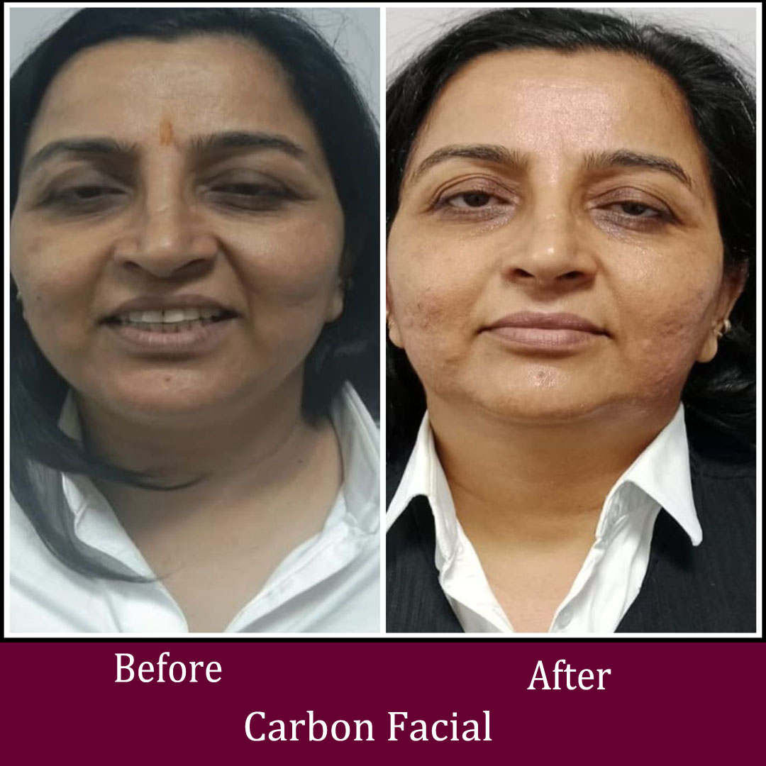 Carbon Facial