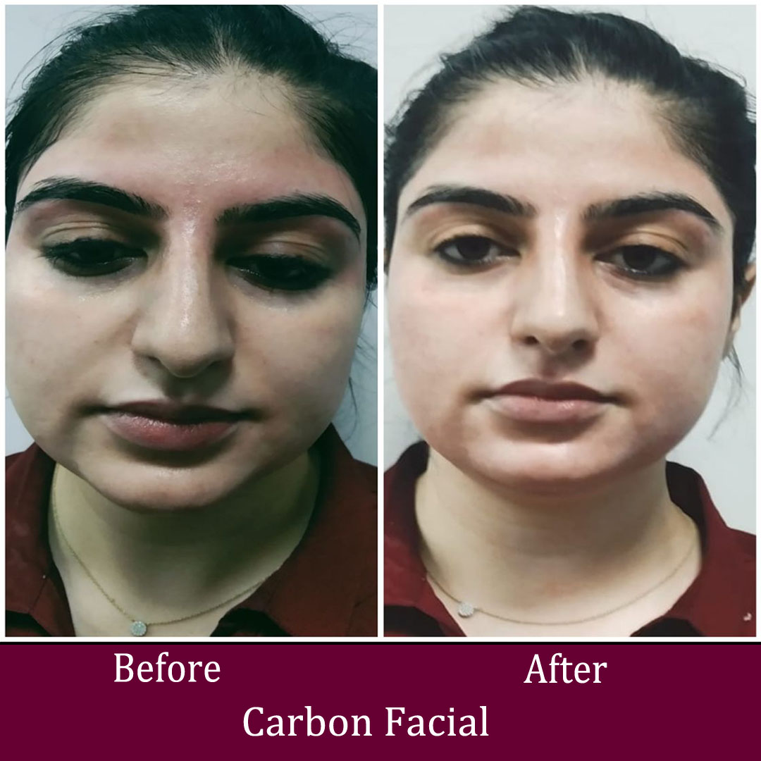 Carbon Facial