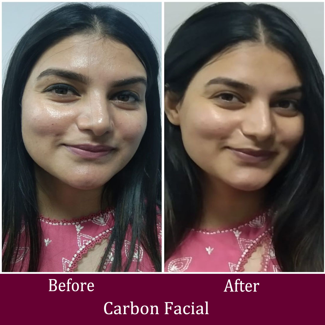 Carbon Facial