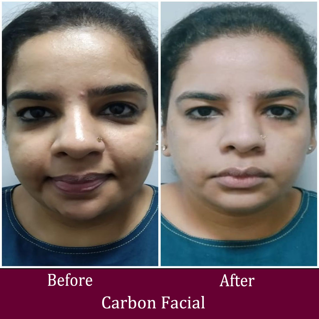 Carbon Facial