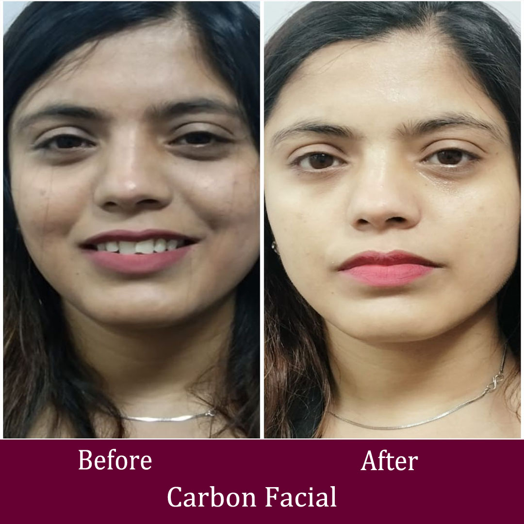 Carbon Facial