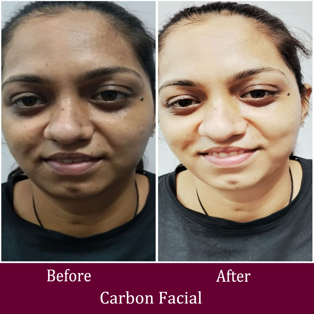 Carbon Facial