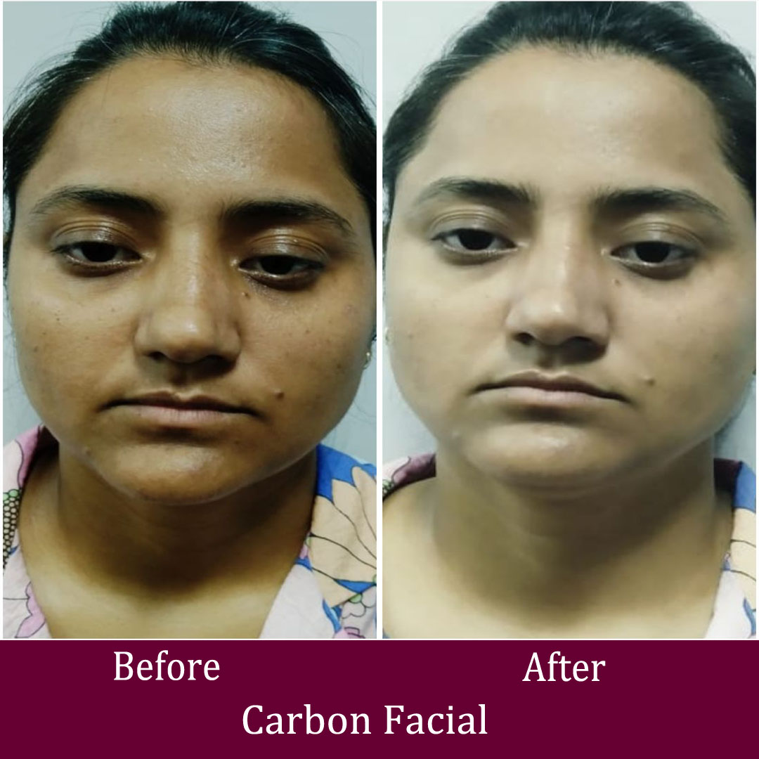 Carbon Facial