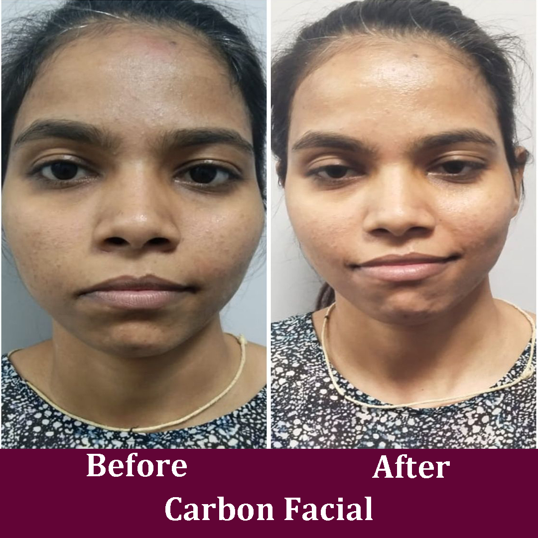 Carbon Facial