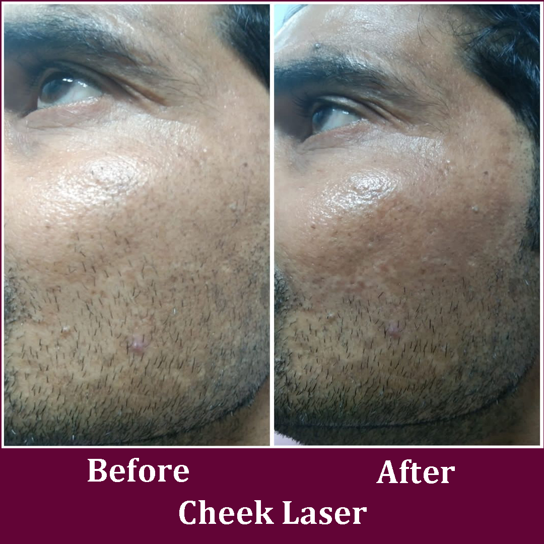 Cheek Laser