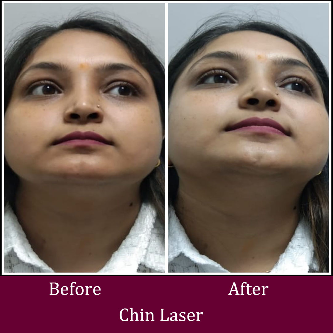 Chin Laser