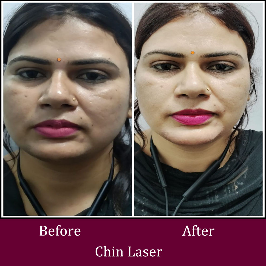 Chin Laser