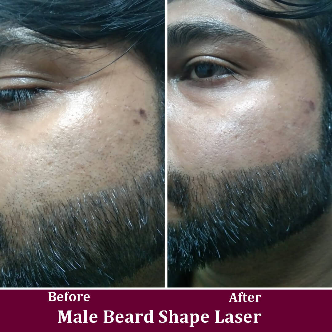 Male Beard Shapping Laser