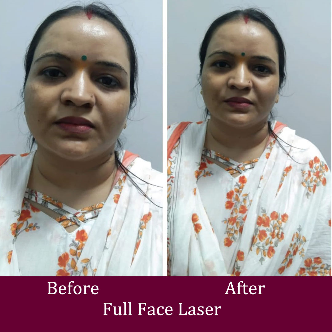 Full Face Laser