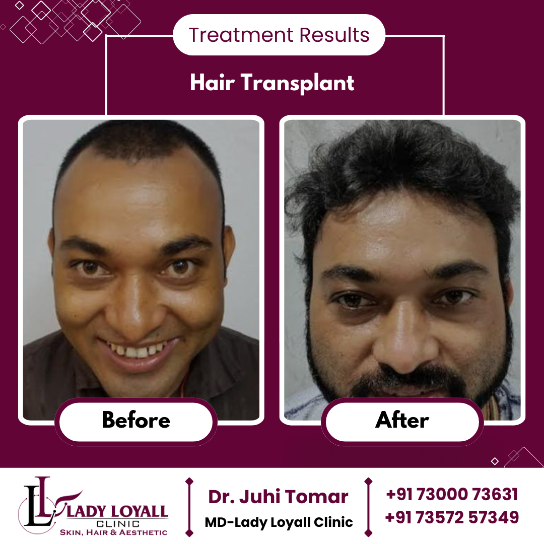 Hair Transplant