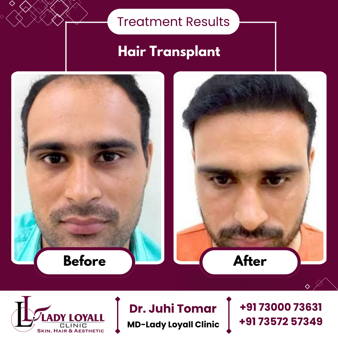 Hair Transplant