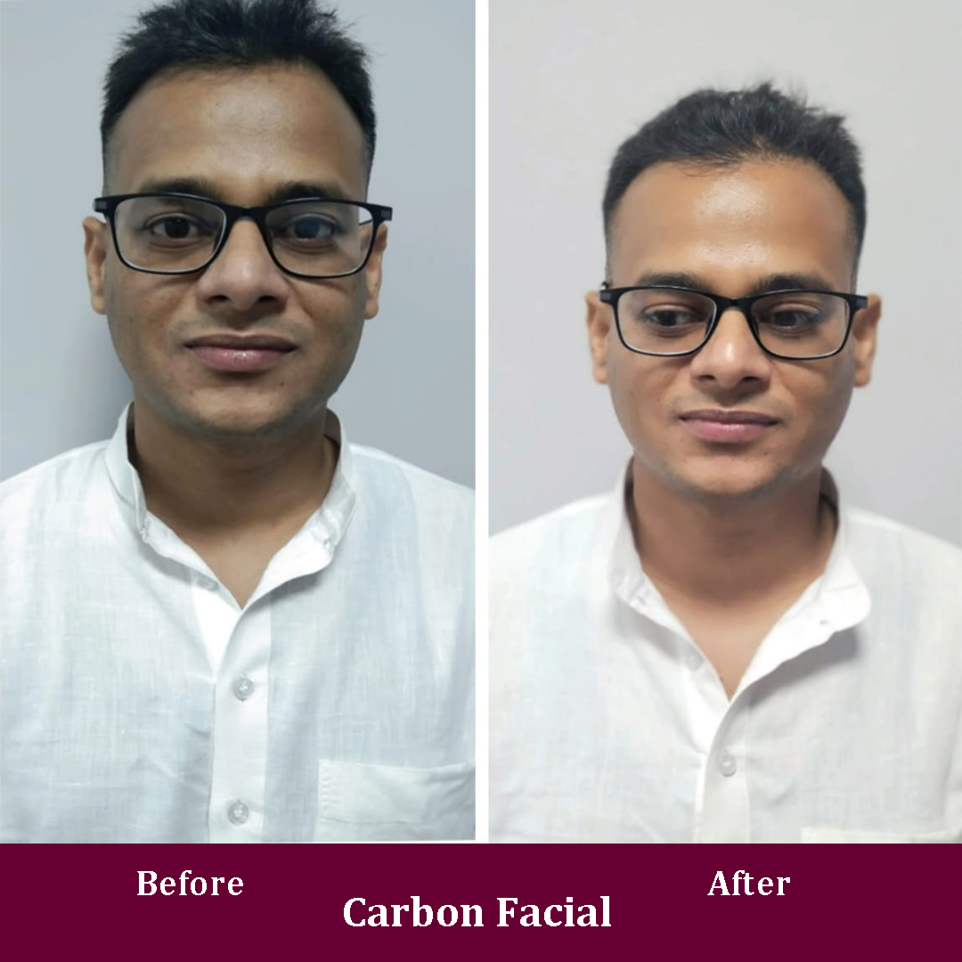 Carbon Facial