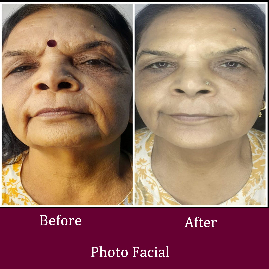 Photo Facial