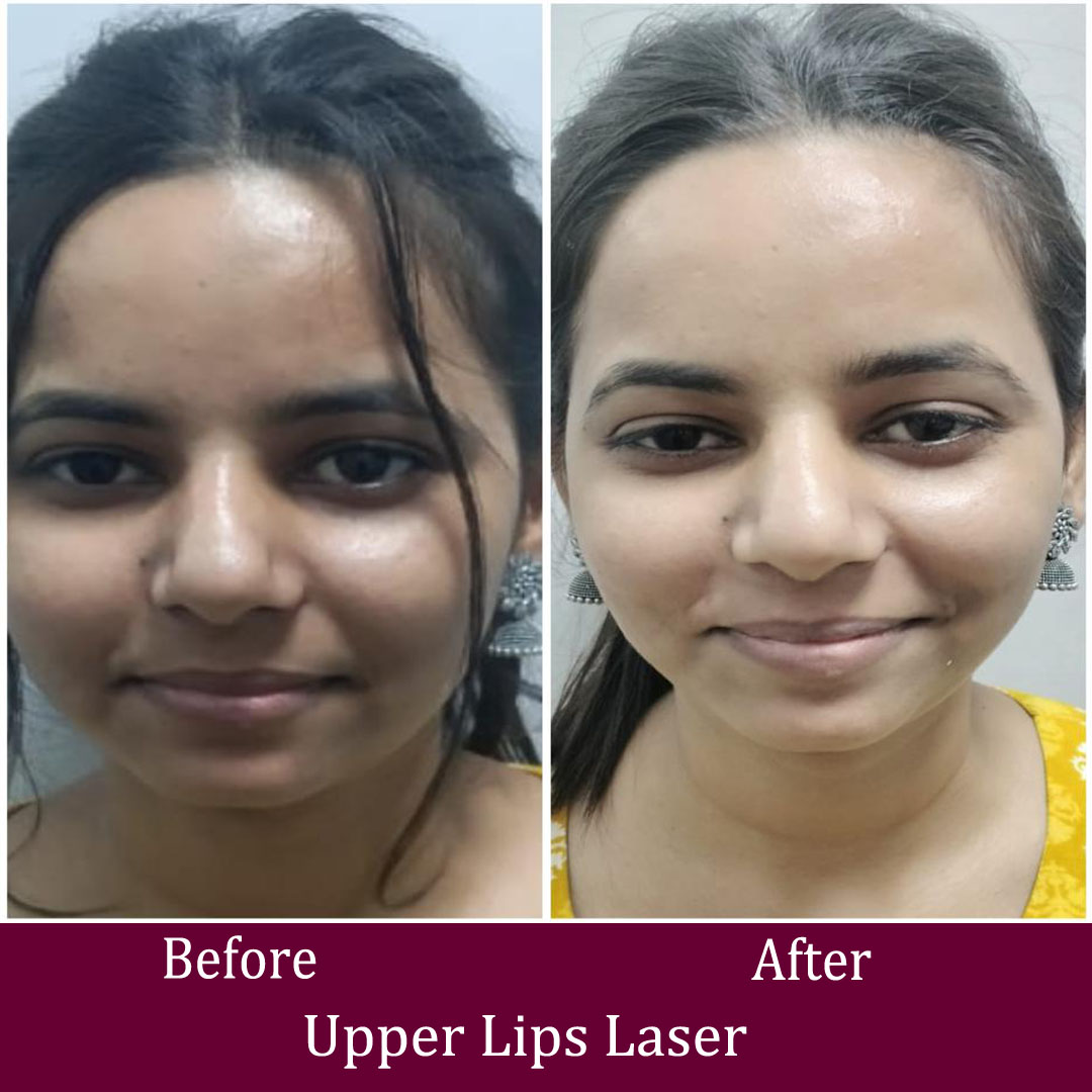 Upper Lips Laser